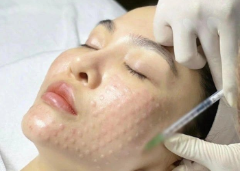 Meso therapy